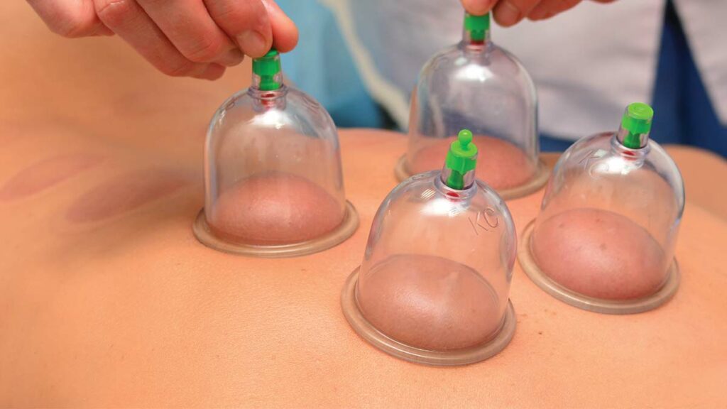 cupping therapy
