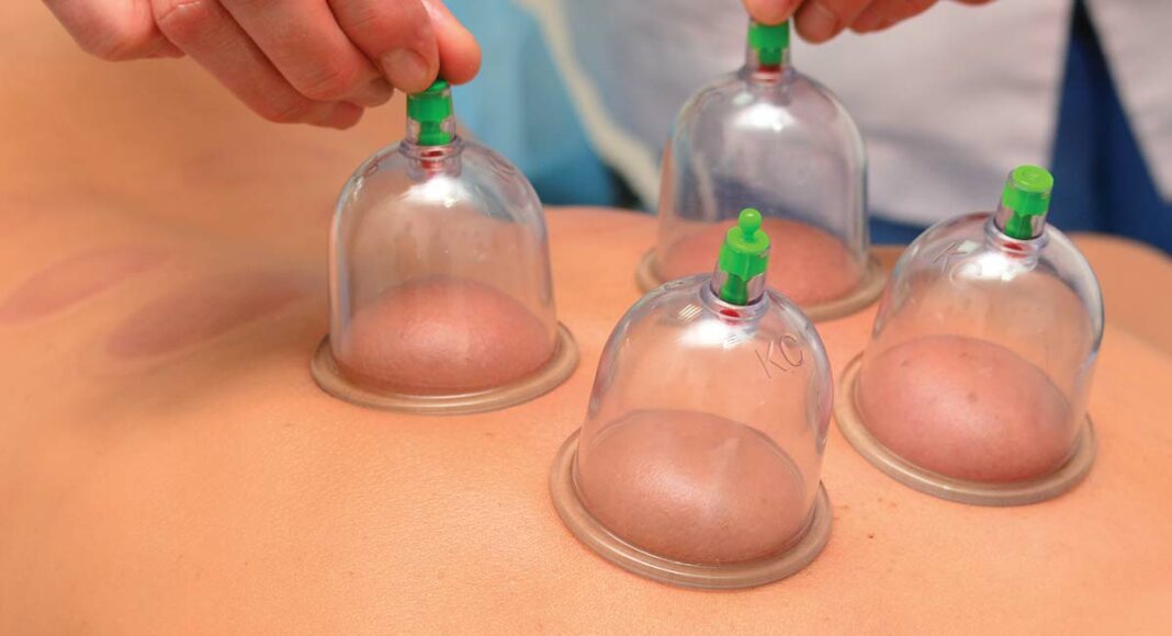 cupping-wellness cupping therapy